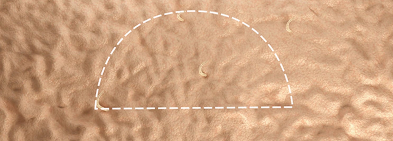 Skin Biopsy video_desktopimage