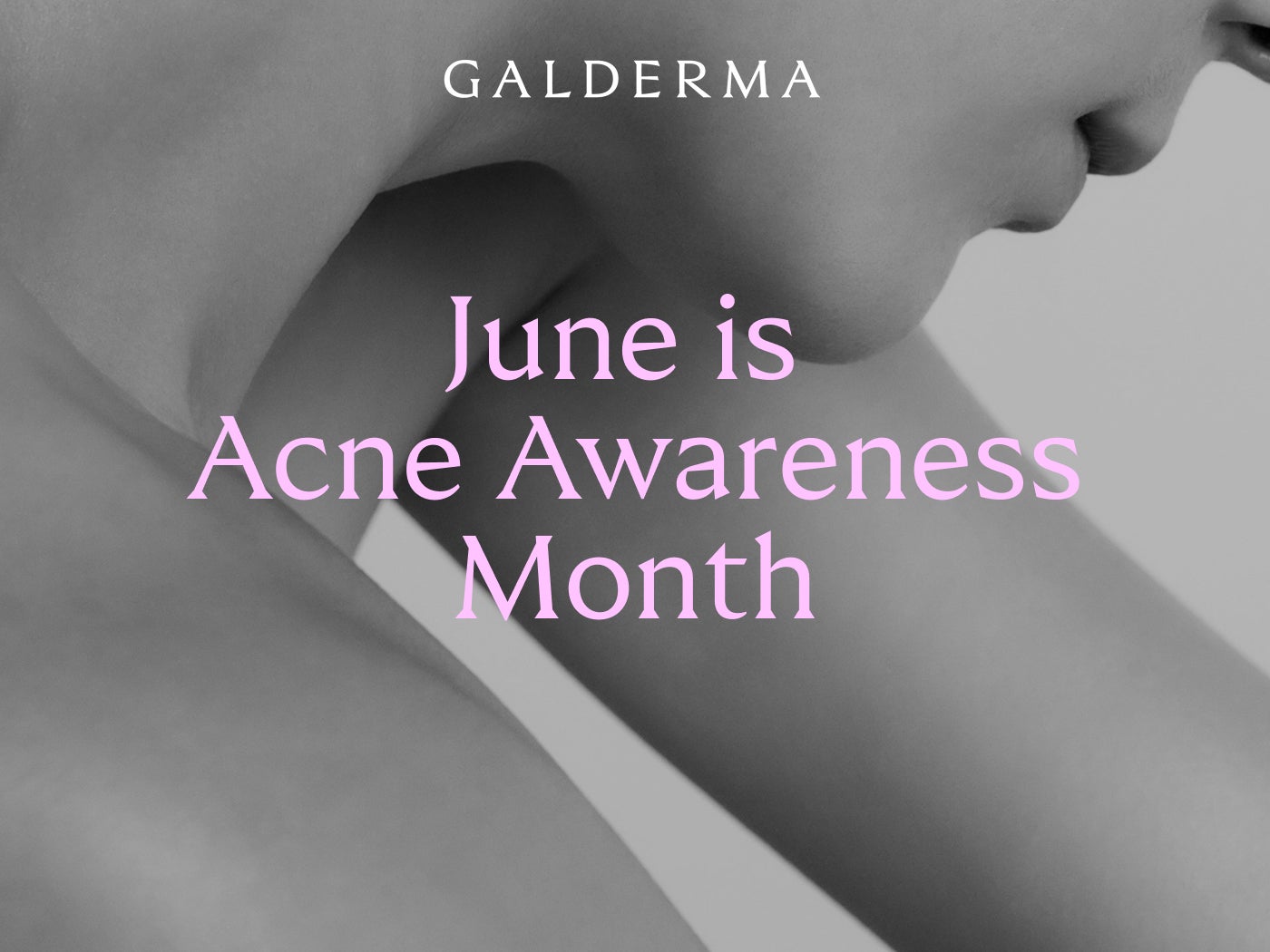 Acne Awareness Month 2025