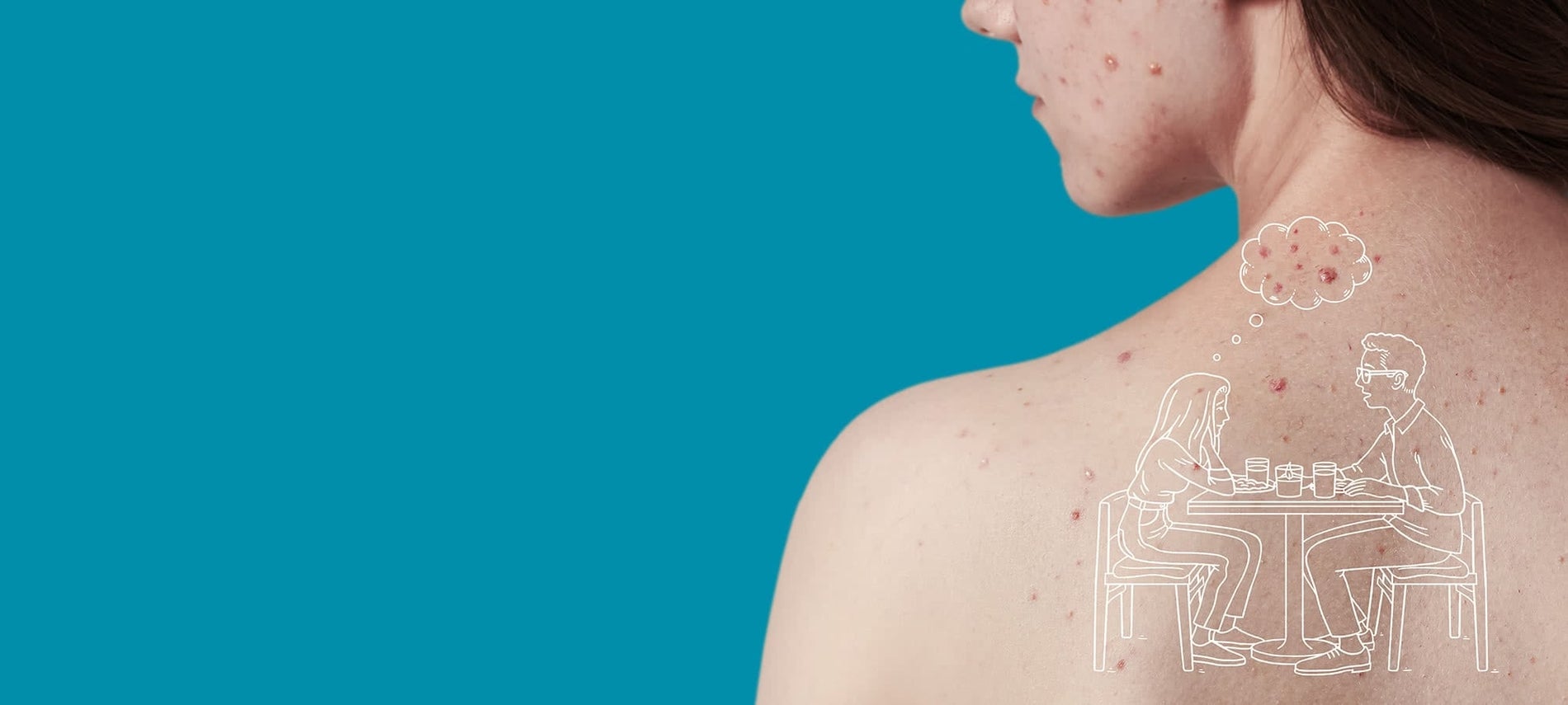 Girl with acne on her face and back. 