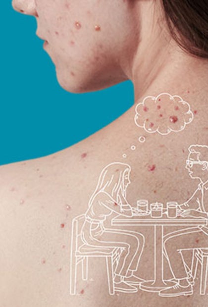 Girl with acne on her face and back. 